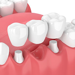 Dental Bridge Procedure in Green Bay and De Pere, WI