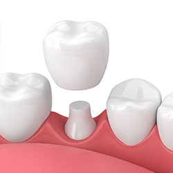 Dental Crown Procedure in Green Bay and De Pere, WI