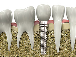 Dental Implant Restoration in Green Bay and De Pere, WI