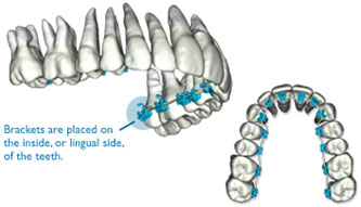 SureSmile QT Lingual Braces teeth models